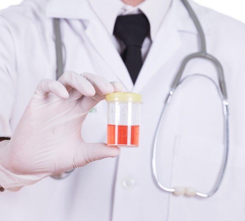 Gota de sangre visible en orina, posible hematuria