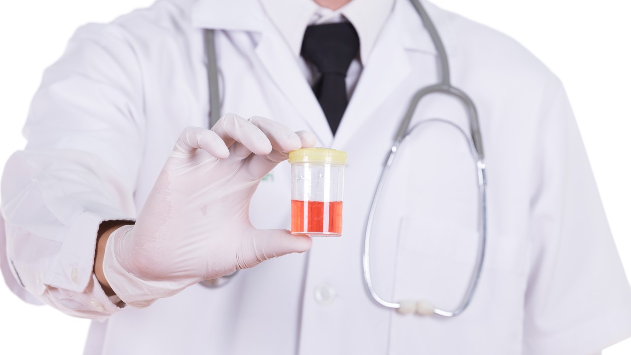 La sangre en la orina: una señal de alarma que no debe ignorarse