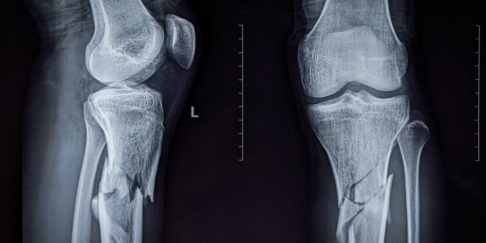 Radiografía o ilustración de huesos frágiles, simbolizando la pérdida de densidad ósea por medicación tiroidea.