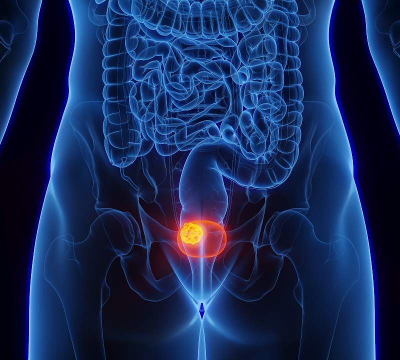 Ilustración de la vejiga humana resaltando un tumor vesical, usada para explicar los síntomas y la detección temprana del cáncer de vejiga.