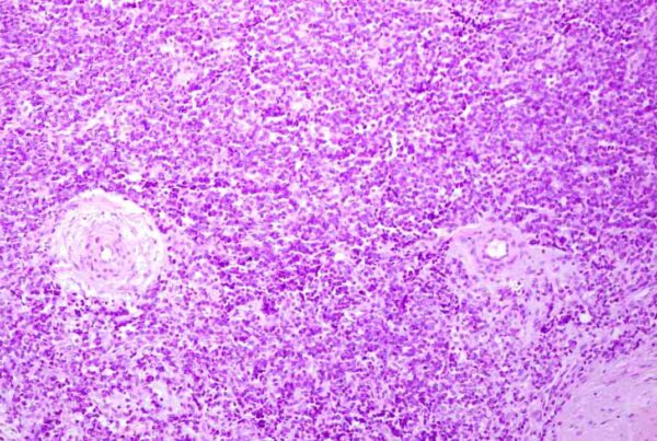 Alt text imagen: Células mesenquimales embrionarias humanas estudiadas para el Sarcoma de Ewing