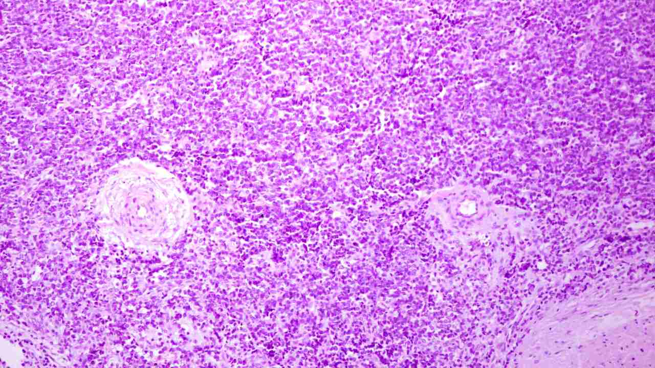 Descubren la célula que inicia el Sarcoma de Ewing