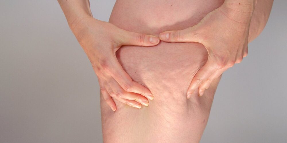Mujer con acumulación de grasa en piernas característica del lipedema