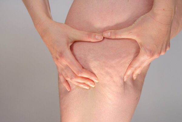 Mujer con acumulación de grasa en piernas característica del lipedema