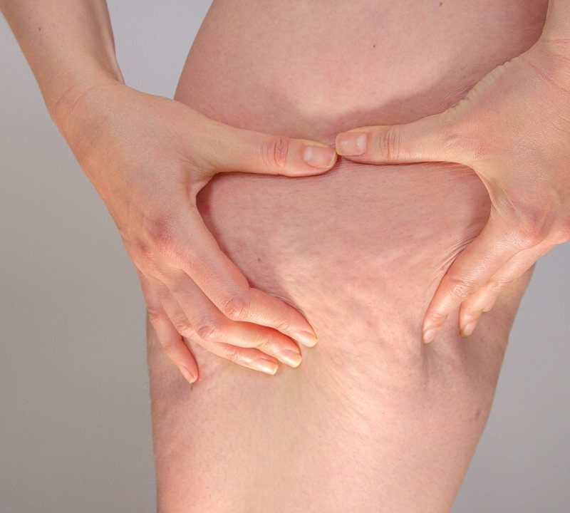 Mujer con acumulación de grasa en piernas característica del lipedema