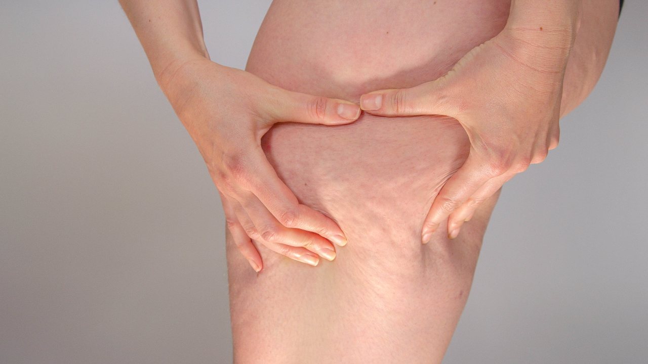 Cuando la grasa en las piernas no es obesidad puede ser lipedema