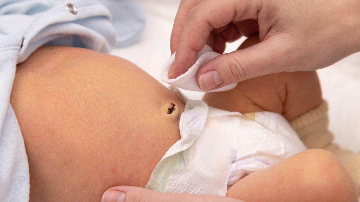 Recién nacido con cuidado del cordón umbilical aplicando antiséptico