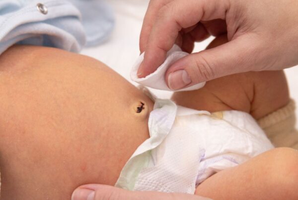 Recién nacido con cuidado del cordón umbilical aplicando antiséptico