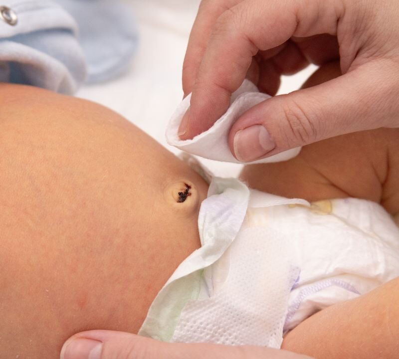 Recién nacido con cuidado del cordón umbilical aplicando antiséptico