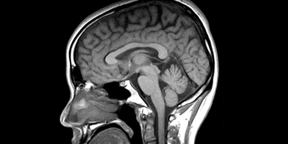 Imagen de resonancia magnética cerebral en parkinsonismos atípicos