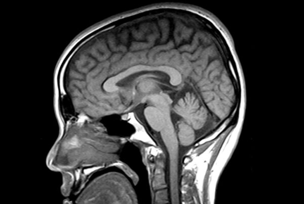 Imagen de resonancia magnética cerebral en parkinsonismos atípicos