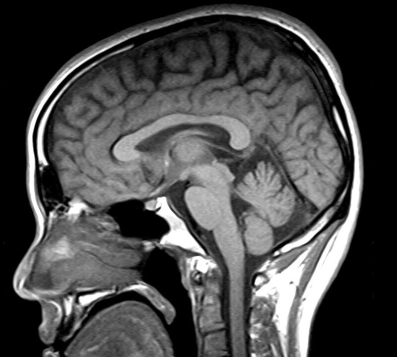 Imagen de resonancia magnética cerebral en parkinsonismos atípicos