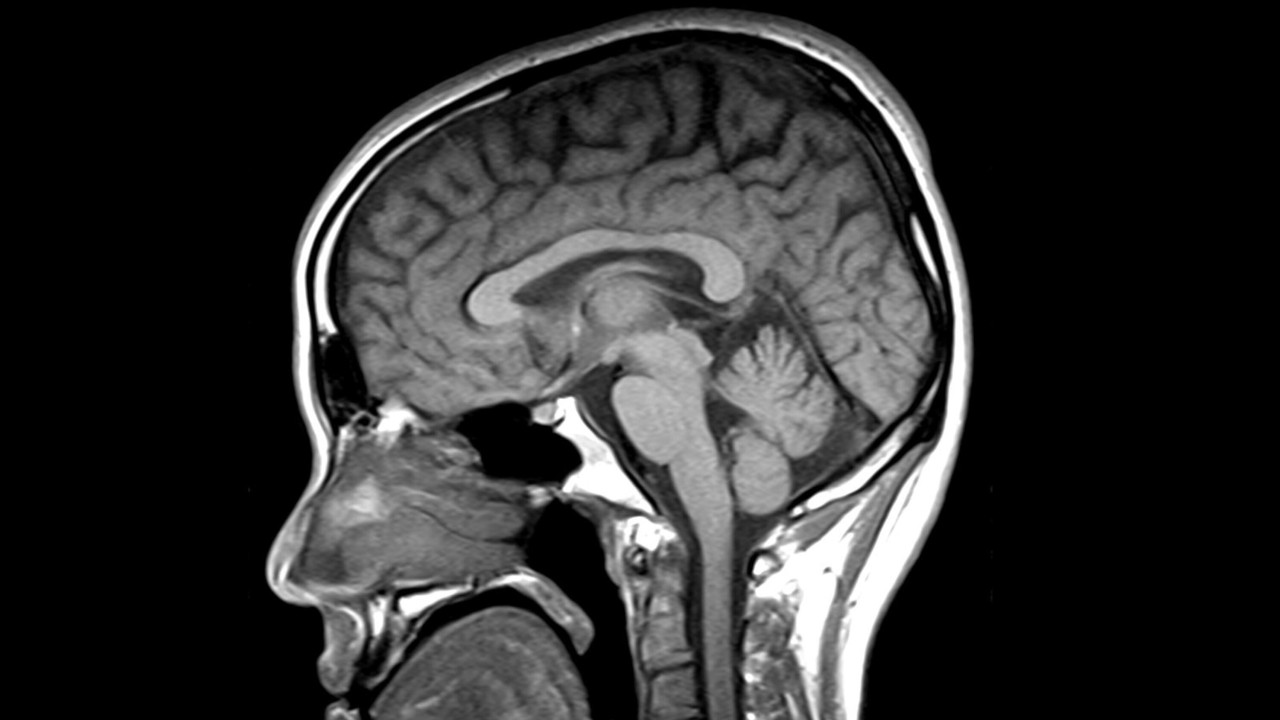 Resonancia detecta enfermedades que imitan Parkinson