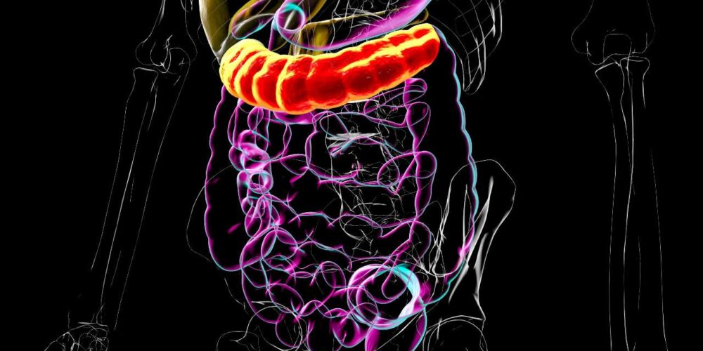 Ilustración del intestino grueso resaltando el colon