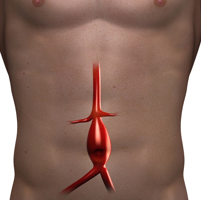 aneurisma aórtico abdominal
