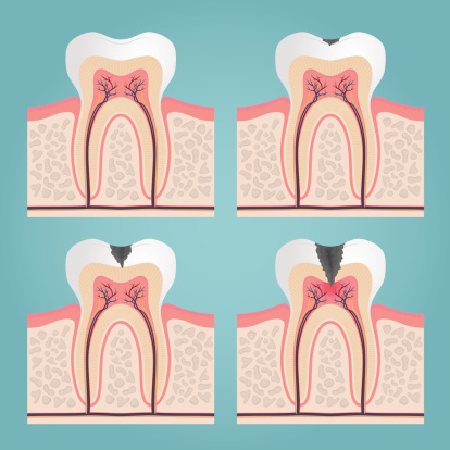 ¿Qué es la caries dental?