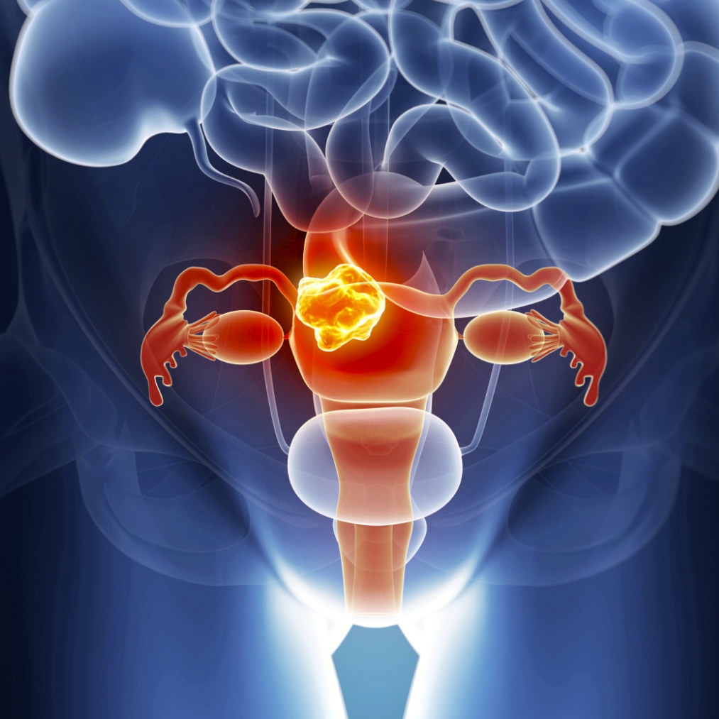 Los beneficios de la soya para el cáncer de cuello uterino son cuestionables
