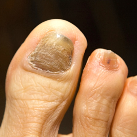 La quimioterapia: Cómo contrarrestar sus efectos en las uñas y la piel
