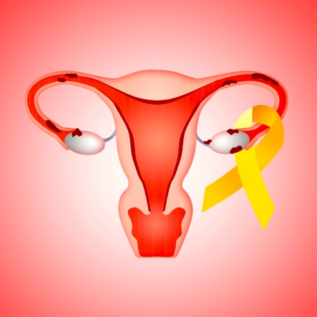 10 consejos para aliviar los síntomas de la endometriosis