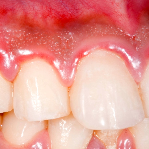 Gingivitis: la inflamación de las encías