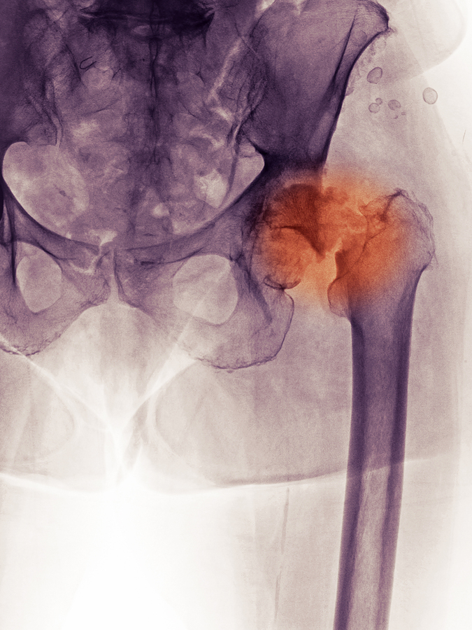 La fractura de cadera podría aumentar el riesgo de muerte anticipada en las mujeres afectadas