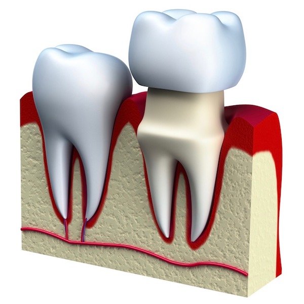 ¿Qué es una corona dental?