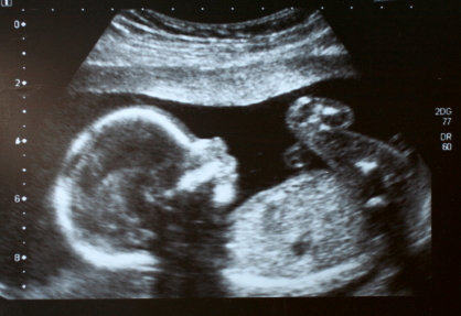 Lo que necesitas saber sobre los ultrasonidos o ecografías prenatales