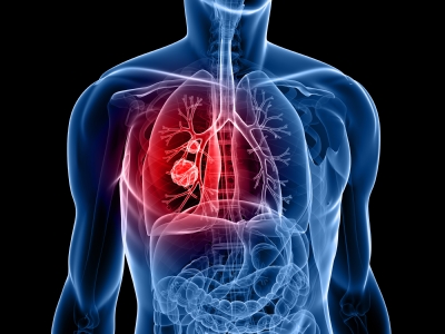 cáncer del pulmón