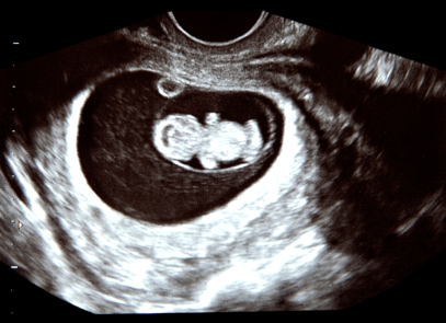 Un examen de sangre detecta el sexo del bebé a las 7 semanas de embarazo
