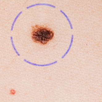 Surgen avances en el tratamiento del melanoma