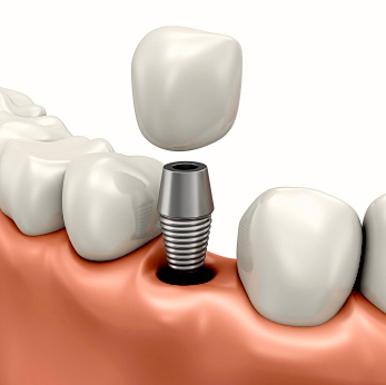 Los implantes dentales, ¿son la mejor alternativa?