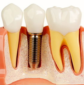 Nuevos implantes dentales al alcance de más pacientes