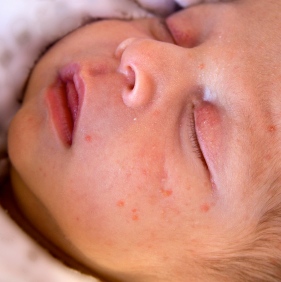 Esa erupción en la piel de tu bebé podría deberse simplemente al calor