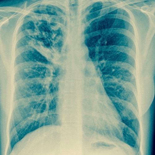 La tuberculosis: un problema de salud serio