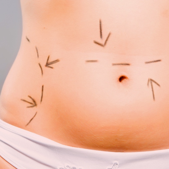 Abdominoplastia, el último recurso para tener un abdomen plano