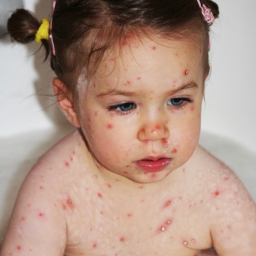 La varicela: una enfermedad contagiosa común entre los niños