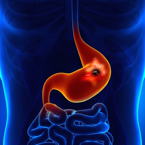 Cáncer del estómago: síntomas y factores de riesgo