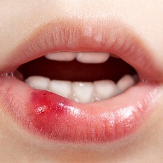 Estomatitis: tipos, causas y tratamiento de estas lesiones en la boca