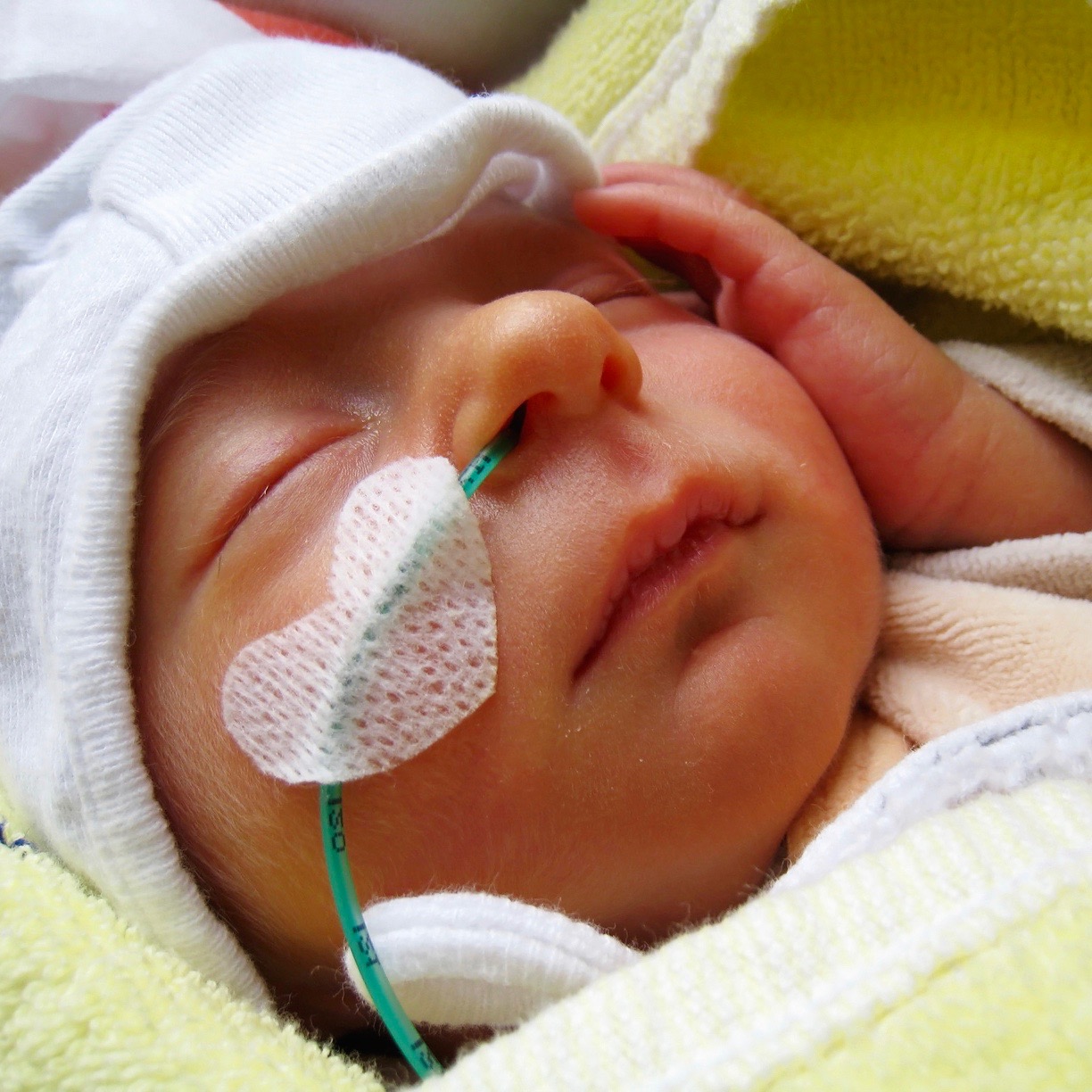 Lo que necesitas saber sobre los defectos de nacimiento (las malformaciones congénitas)