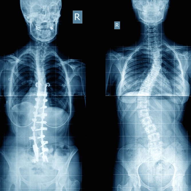 Escoliosis en los adultos mayores: la osteoporosis es un factor de riesgo