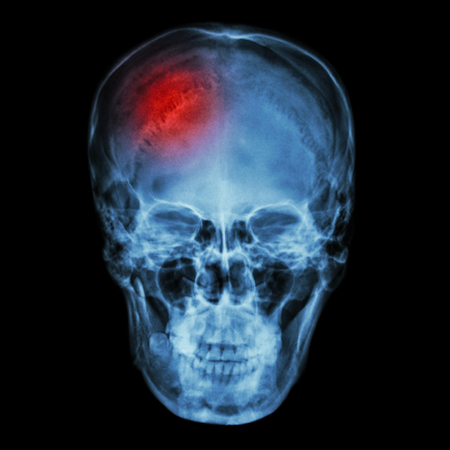 SOS en tu cerebro: Señales de alerta de una apoplejía o derrame cerebral