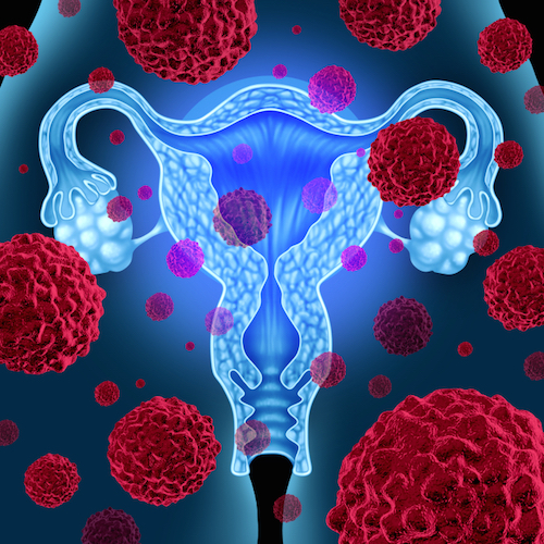Cáncer del ovario: otro enemigo de las mujeres